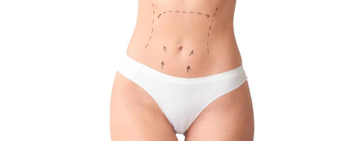 Lipoabdominoplastie haute définition (HD)