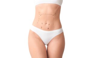 Lipoabdominoplastie haute définition (HD)