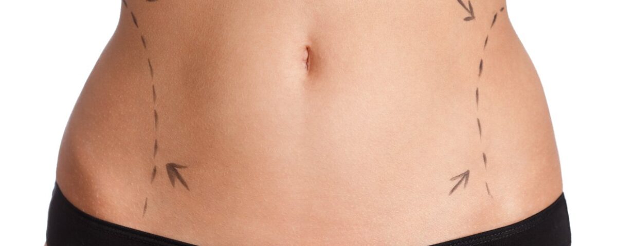 Liposuccion abdominale chez les femmes de plus de 40 ans