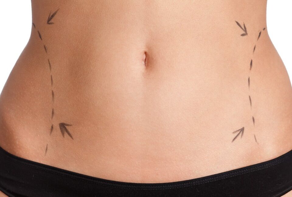 Liposuccion abdominale chez les femmes de plus de 40 ans