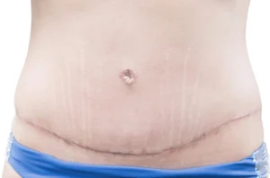 Techniques modernes pour réduire les cicatrices après abdominoplastie