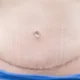 Techniques modernes pour réduire les cicatrices après abdominoplastie