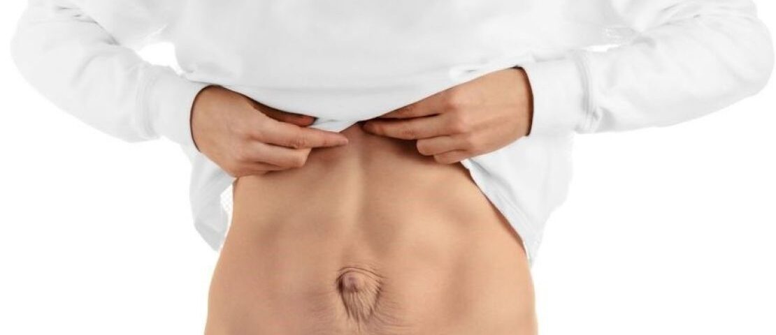 Traitement du diastasis abdominal