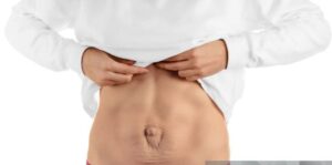 Traitement du diastasis abdominal