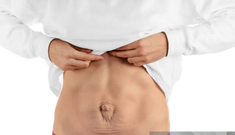 Traitement du diastasis abdominal