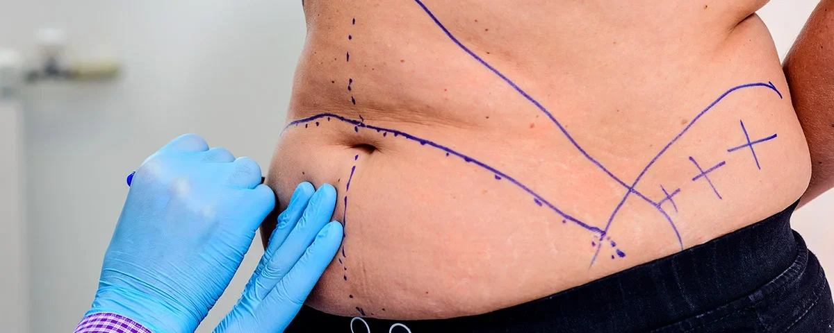abdominoplastie après perte de poids