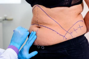 abdominoplastie après perte de poids