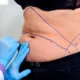 abdominoplastie après perte de poids