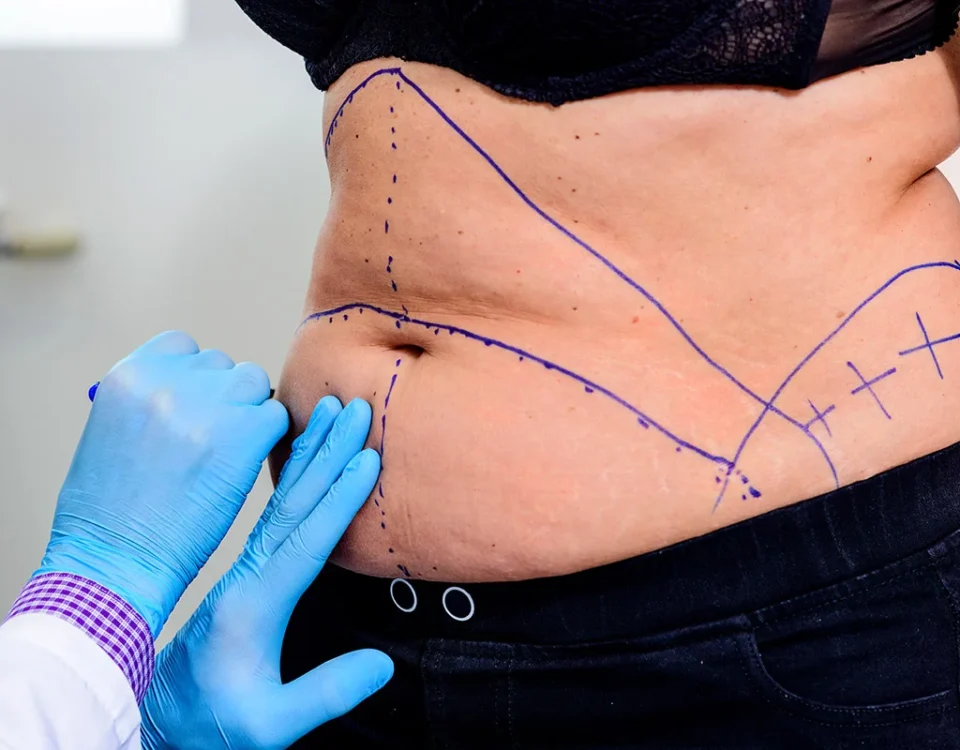 abdominoplastie après perte de poids