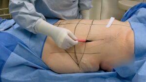Abdominoplastie assistée par liposuccion WAL