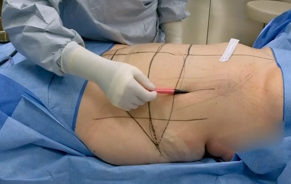 Abdominoplastie assistée par liposuccion WAL