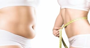 Body contouring du ventre