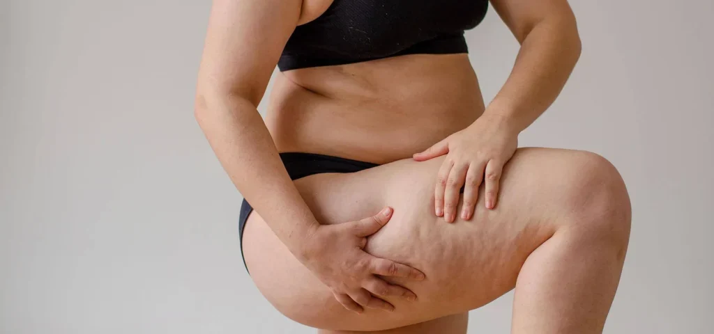 Faut-il traiter le lipœdème par liposuccion avant une abdominoplastie