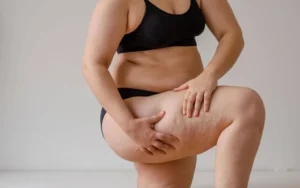 Faut-il traiter le lipœdème par liposuccion avant une abdominoplastie