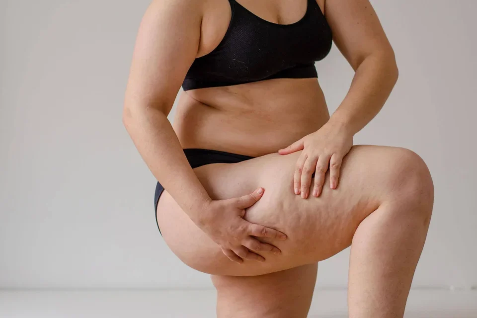 Faut-il traiter le lipœdème par liposuccion avant une abdominoplastie