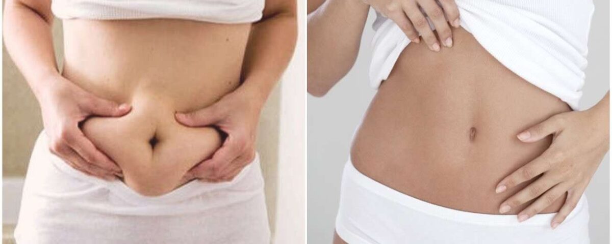 Abdominoplastie HD vs classique