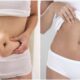 Abdominoplastie HD vs classique