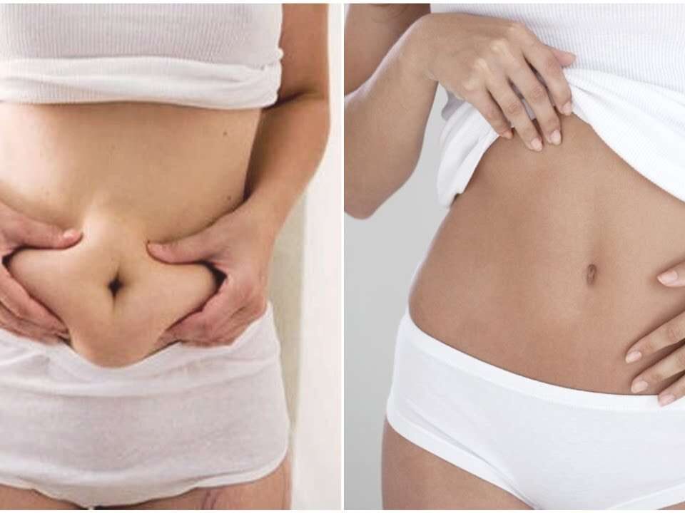 Abdominoplastie HD vs classique