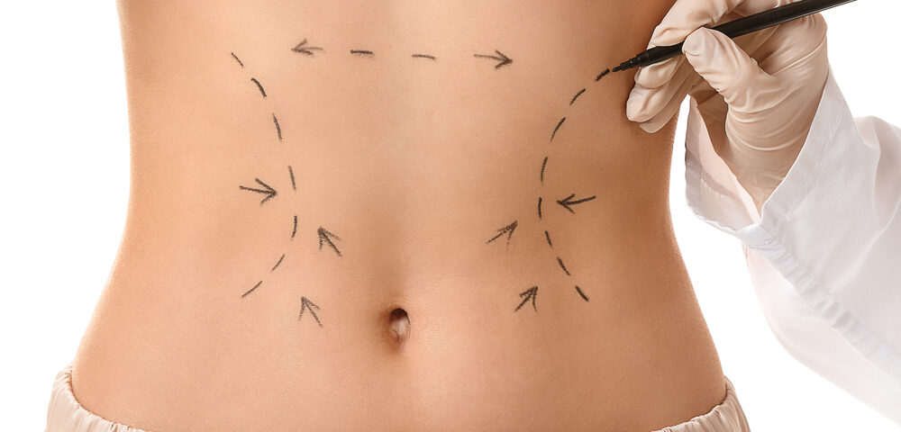 Abdominoplastie et Renuvion (J-Plasma)