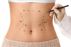 Abdominoplastie et Renuvion (J-Plasma)