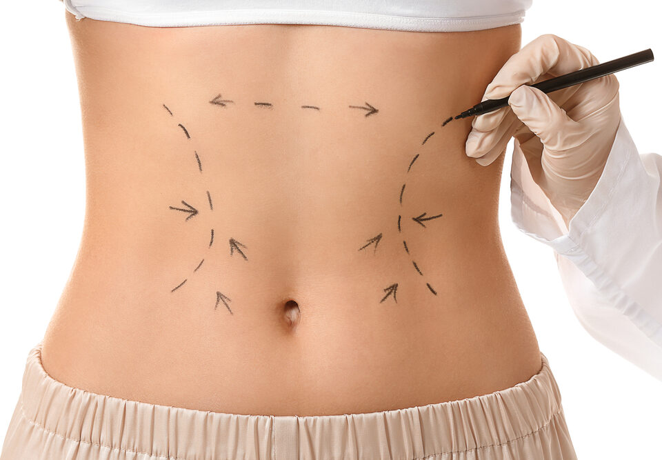 Abdominoplastie et Renuvion (J-Plasma)