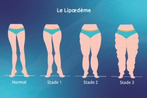 Lipœdème 4-Tech