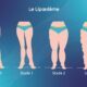 Lipœdème 4-Tech