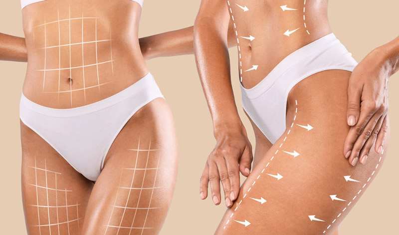 Abdominoplastie combinée avec augmentation des fesses (BBL)