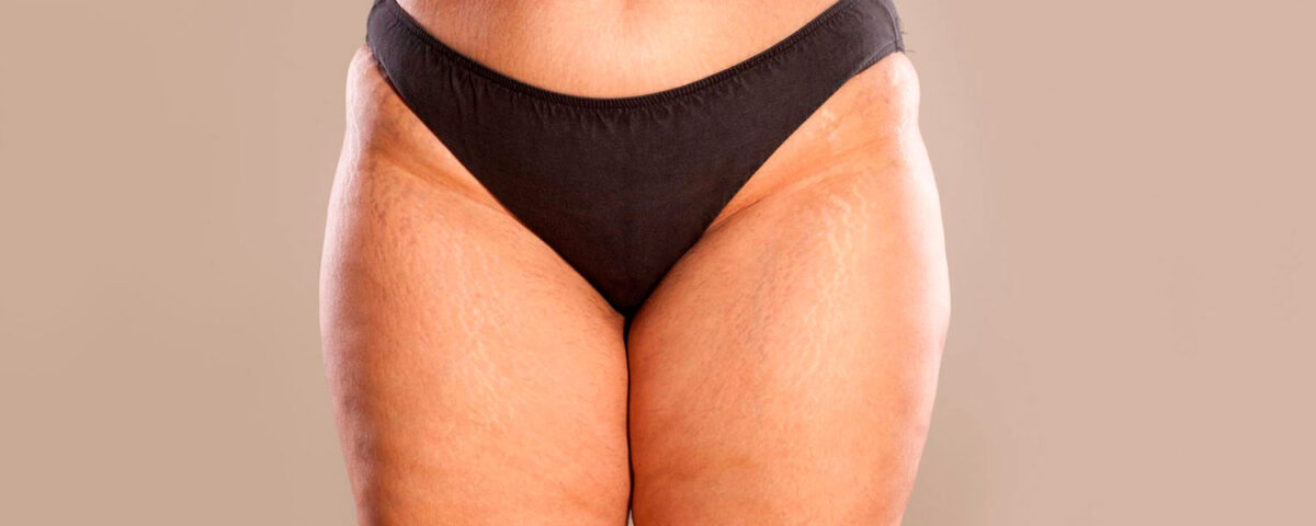 Lipœdème et 4D Lipo n’est pas indiquée