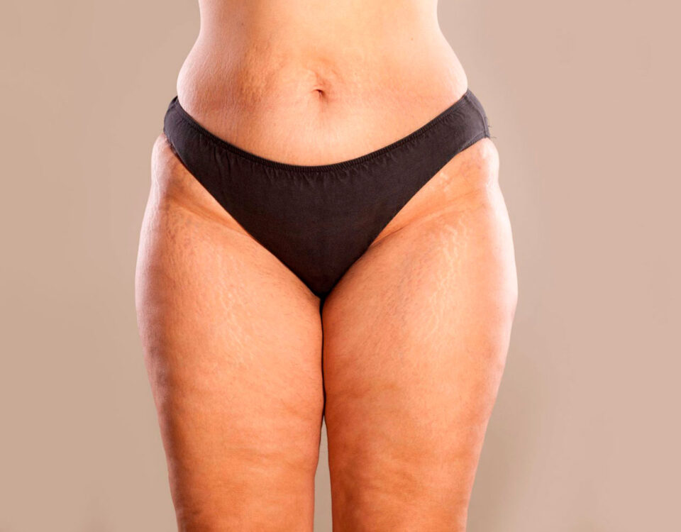 Lipœdème et 4D Lipo n’est pas indiquée