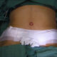 Abdominoplastie avec transposition de l'ombilic