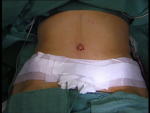 Abdominoplastie avec transposition de l'ombilic