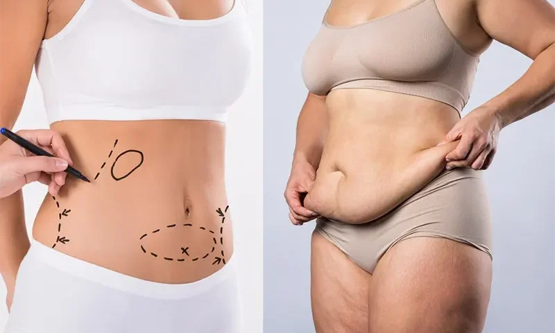 Association liposuccion du lipœdème et abdominoplastie