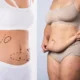 Association liposuccion du lipœdème et abdominoplastie
