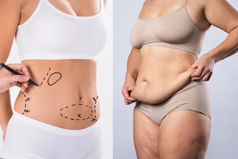 Association liposuccion du lipœdème et abdominoplastie