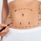Chirurgie du lipœdème interventions complémentaires à l'abdominoplastie