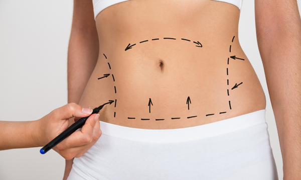 Chirurgie du lipœdème interventions complémentaires à l'abdominoplastie