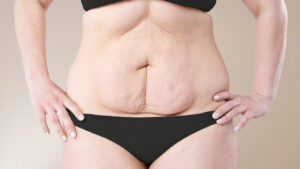 Comment traiter l'excès de peau abdominale après une chirurgie du lipœdème