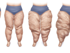 Comment traiter l'excès de peau abdominale après une chirurgie du lipœdème