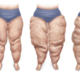 Comment traiter l'excès de peau abdominale après une chirurgie du lipœdème