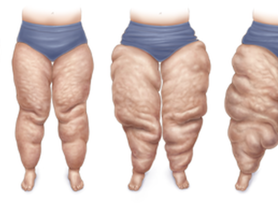 Comment traiter l'excès de peau abdominale après une chirurgie du lipœdème