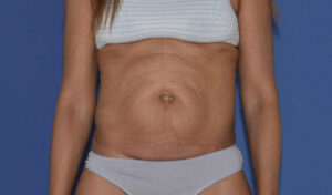 Hernie ombilicale et abdominoplastie