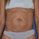 Hernie ombilicale et abdominoplastie