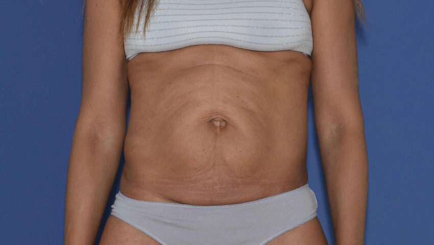 Hernie ombilicale et abdominoplastie