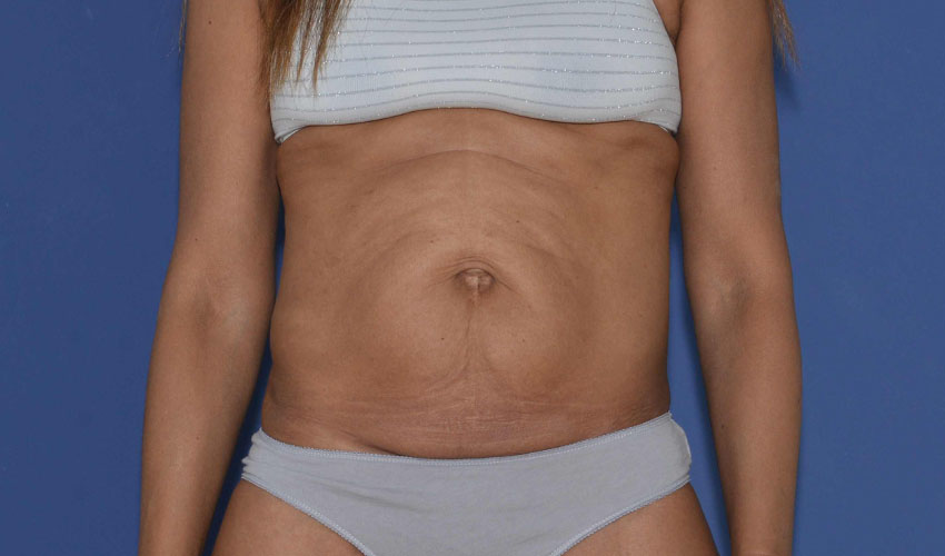 Hernie ombilicale et abdominoplastie