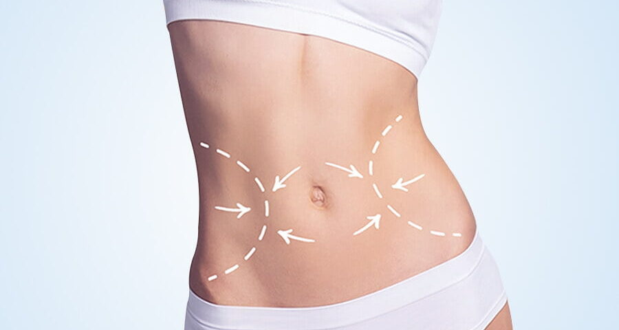 Lipoabdominoplastie