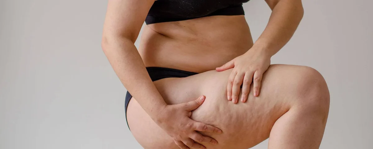 Lipœdème abdominal