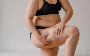 Lipœdème abdominal