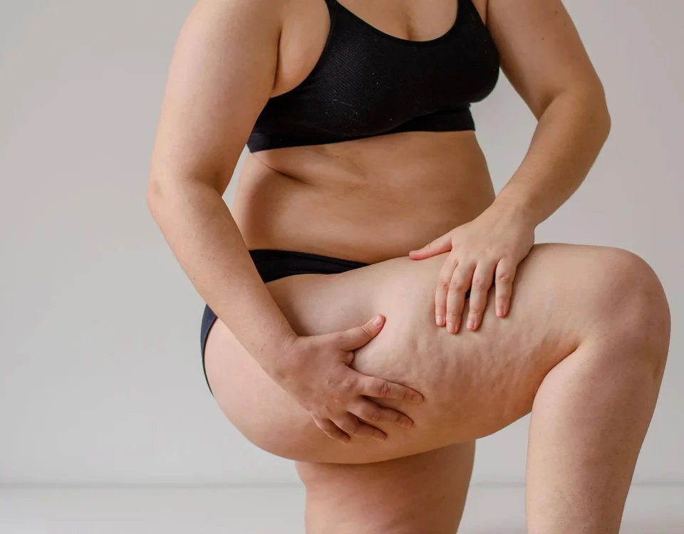 Lipœdème abdominal