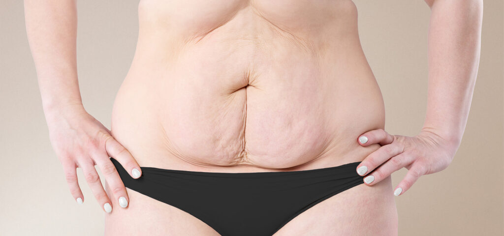 Lipœdème et relâchement abdominal